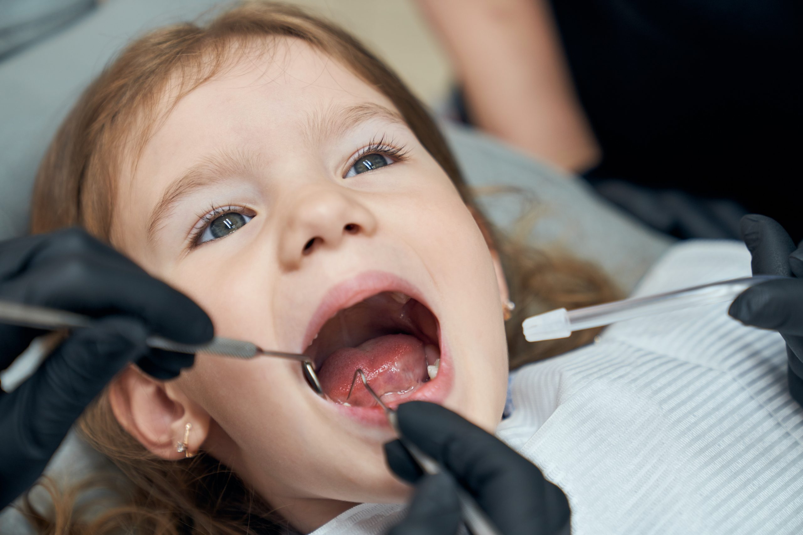 Portrait of pretty bold female child sitting in dental chair with open mouth while professional doctor in rubber gloves carefully examining condition of teeth. Concept of dentistry